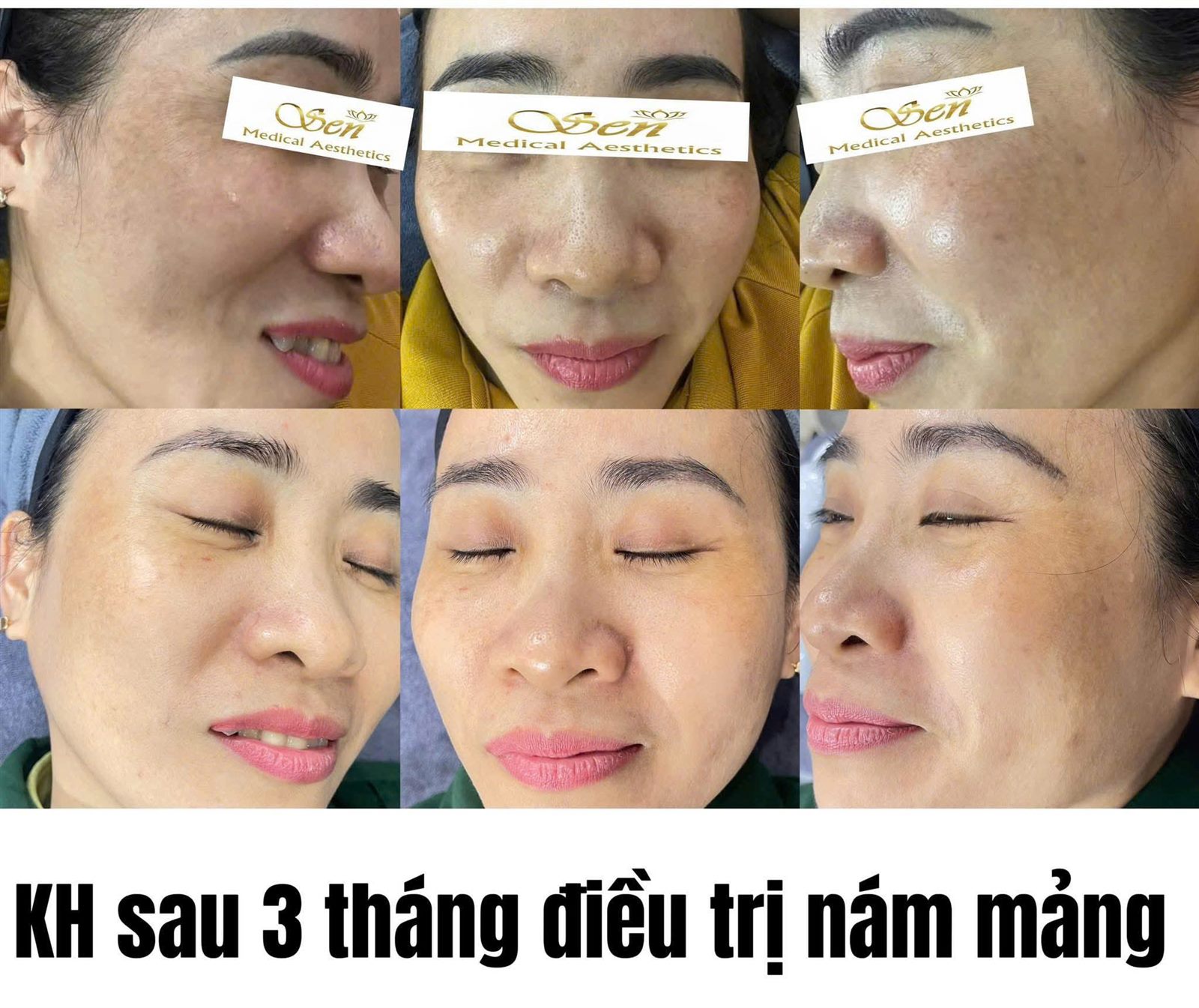 Khách hàng sau 3 tháng điều trị nám mảng tại Sen