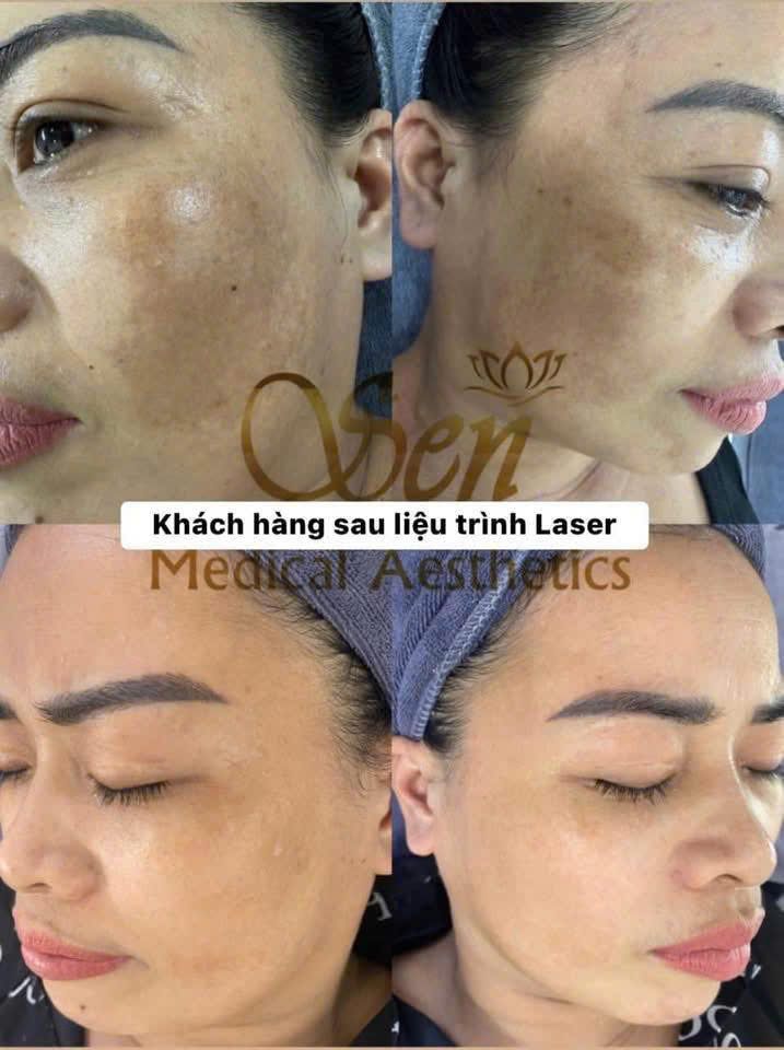 Ca điều trị nám tại Sen