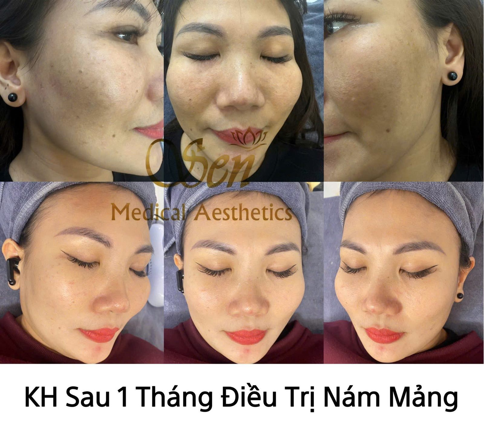 Trước sau điều trị sắc tố tại Sen