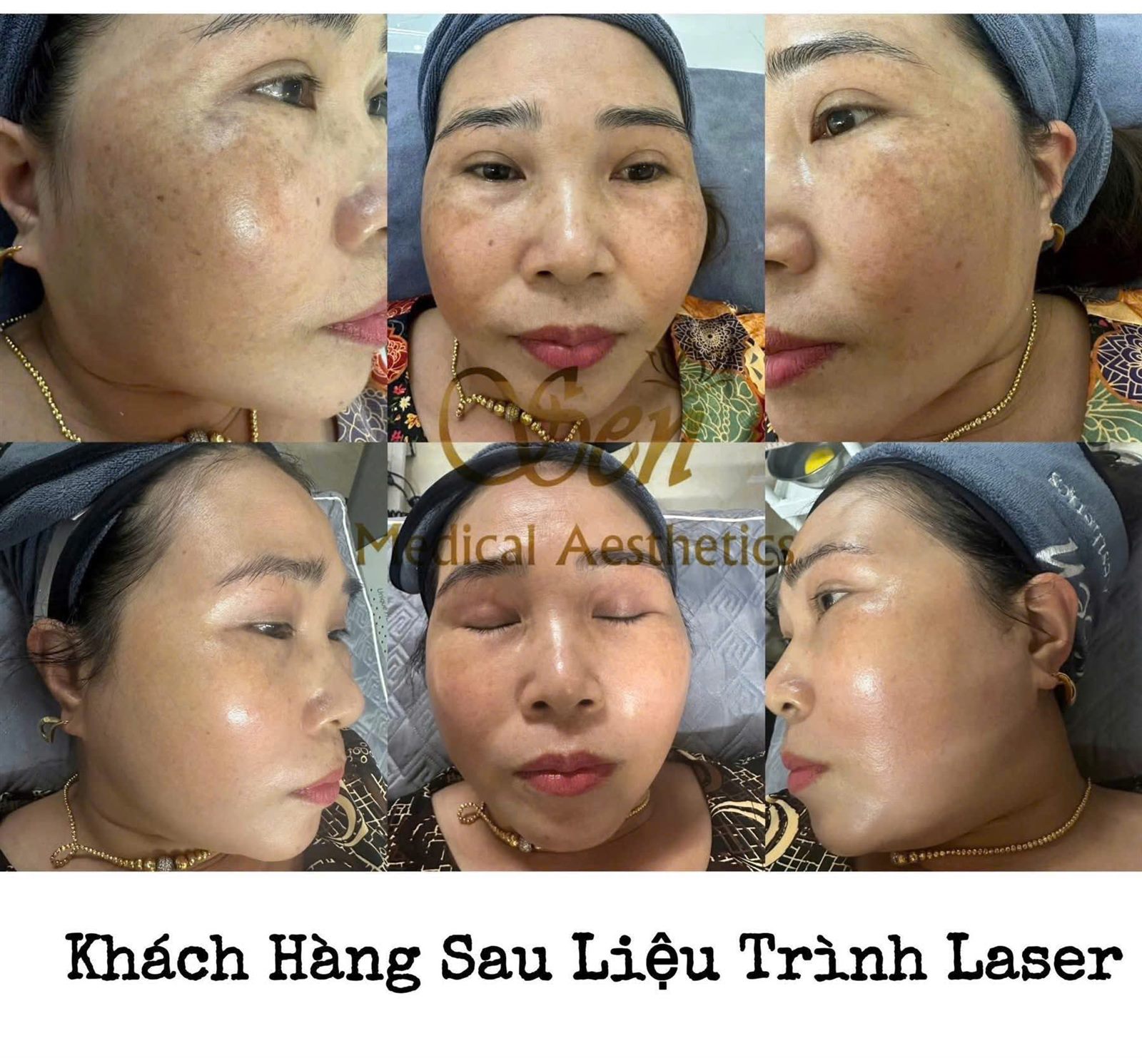 Da sáng khỏe sau liệu trình tại Sen