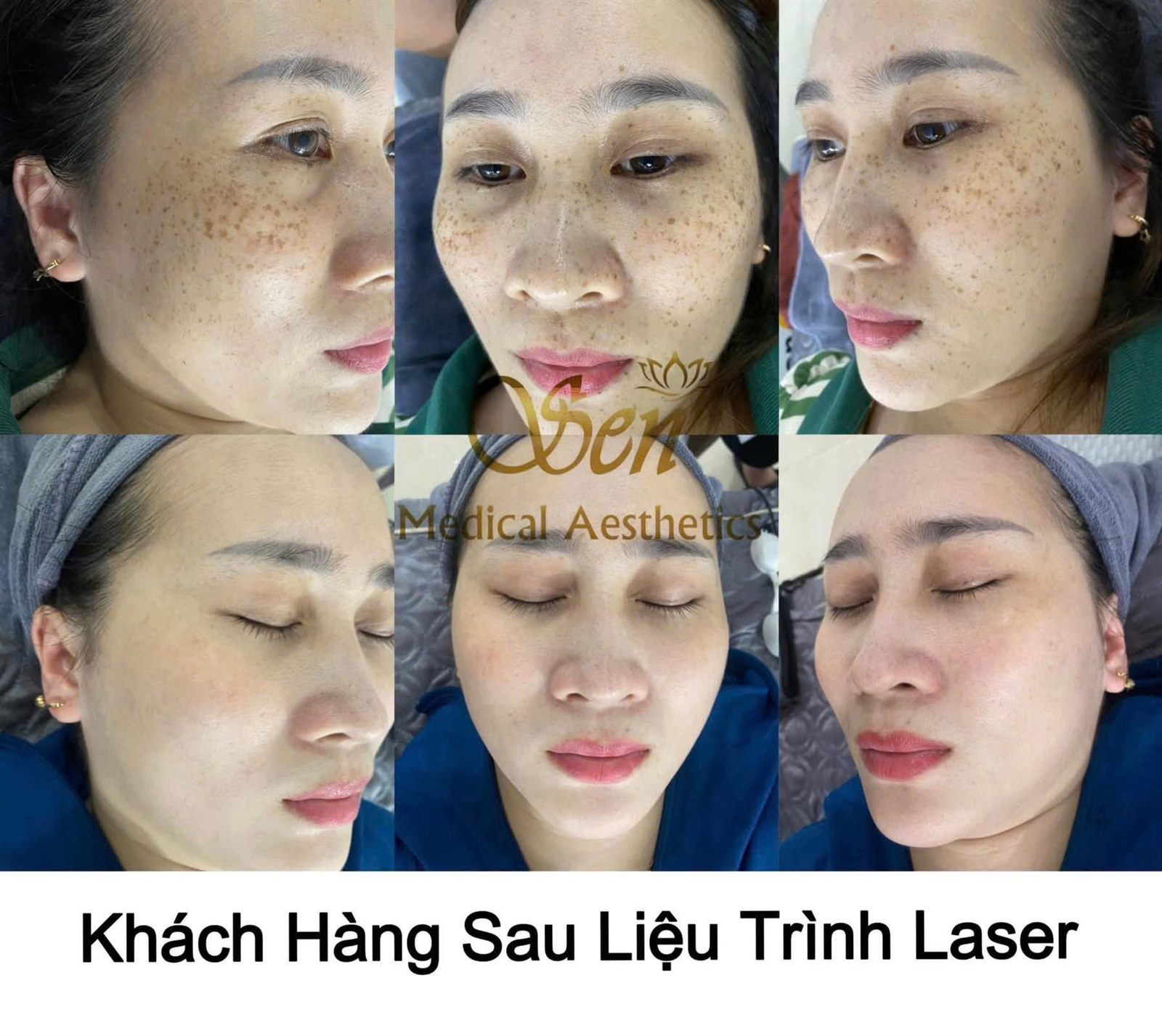 Kết quả điều trị nám tại Sen