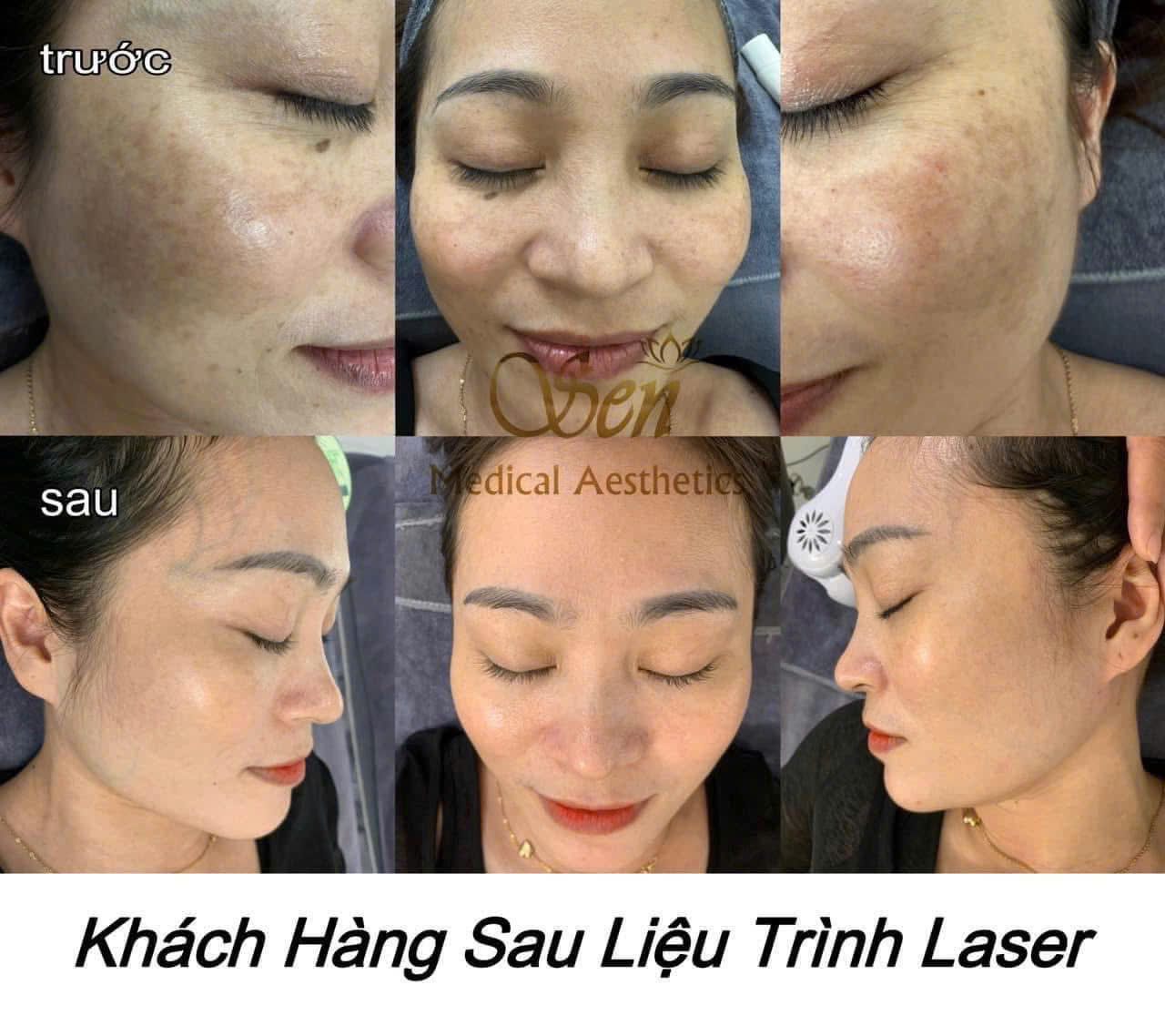 Trước sau điều trị tại Sen