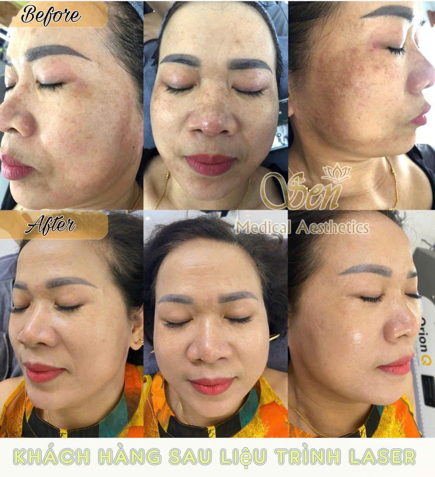 Ca điều trị sắc tố thực tế