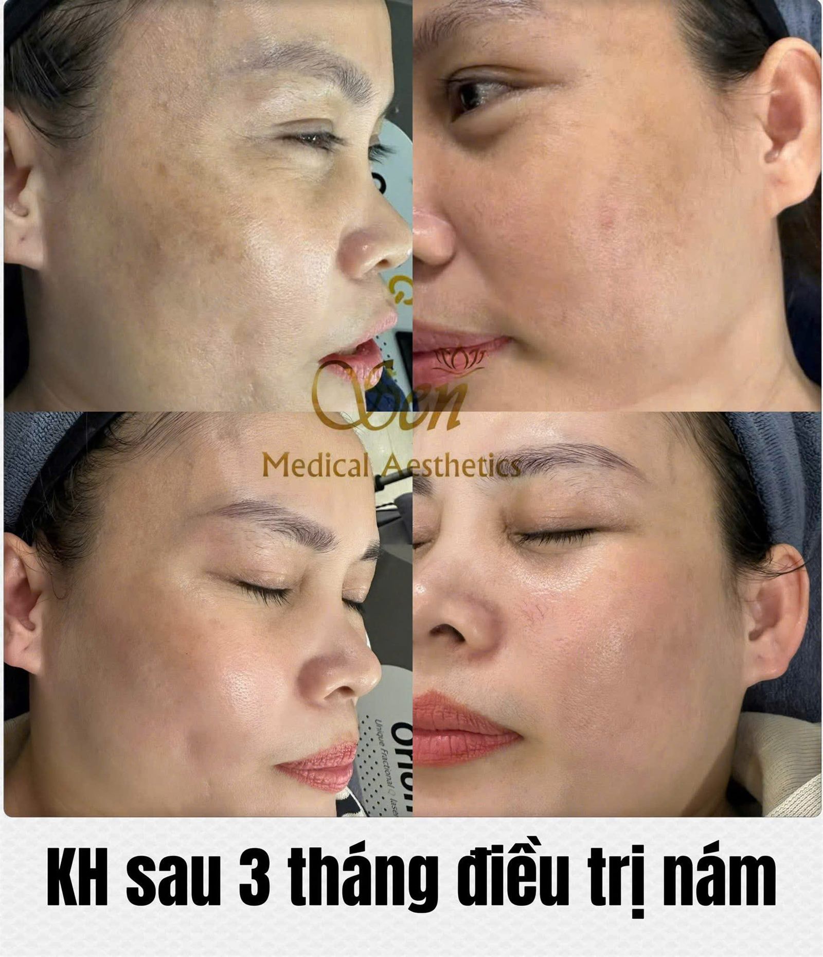 Kết quả sau liệu trình tại Sen