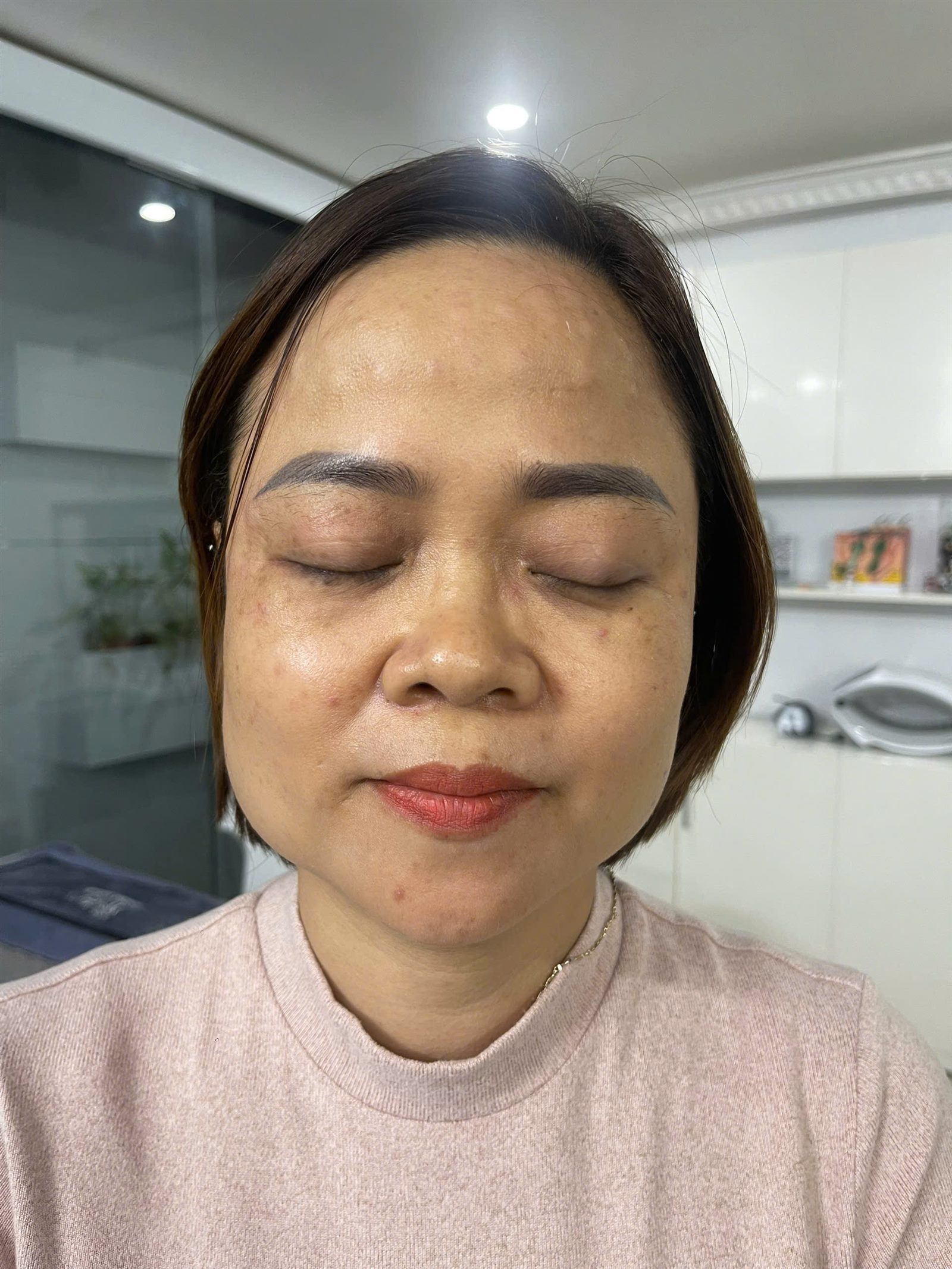 Điều trị mụn và phục hồi da