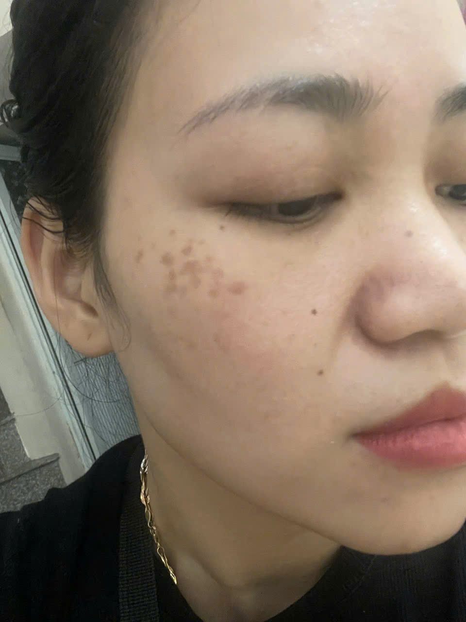 Những sai lầm khi điều trị nám