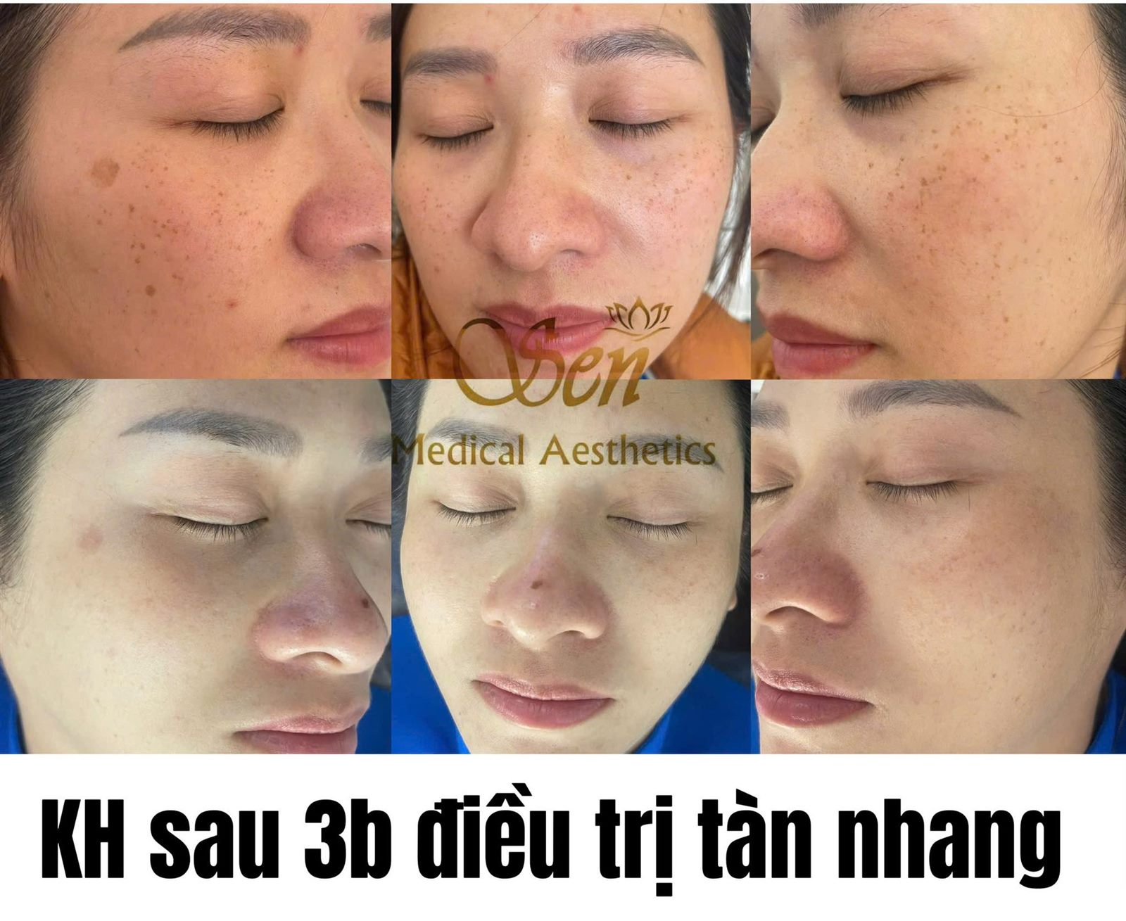 Điều trị tàn nhang tại Sen