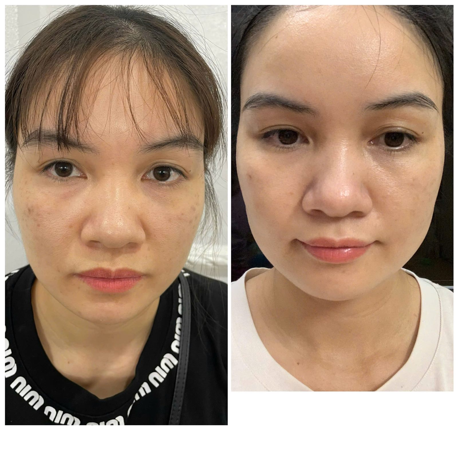 Trước sau điều trị nám