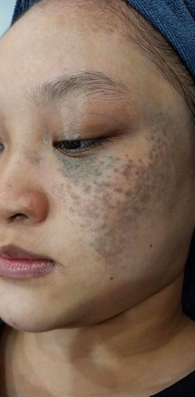 Cảnh báo kem trộn corticoid